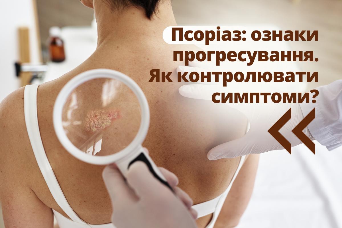 Псоріаз: ознаки прогресування. Як контролювати симптоми?